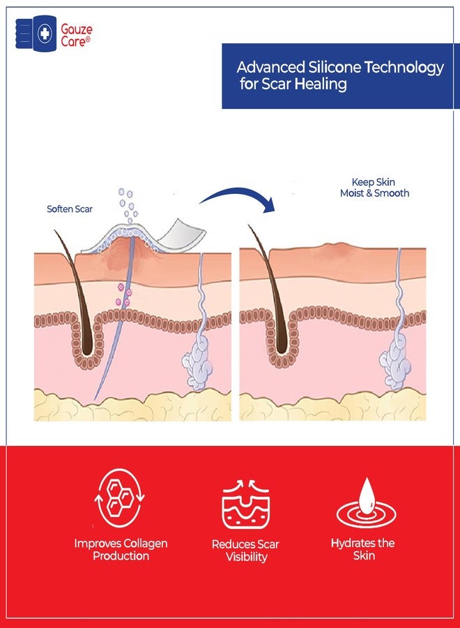 غوز_كير شريط سيليكون GauzeCare لعلاج الندبات - لفة 1.6 بوصة × 120 بوصة - شريط سيليكون طبي قابل لإعادة الاستخدام، مناسب للندبات الجراحية، وندبات الولادة القيصرية، والحروق، والندبات الجدرية، وندبات حب الشباب. - Image 5